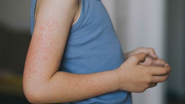 Boy with Measles rash